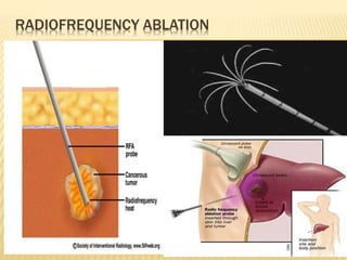 RADIOFREQUENCY ABLATION
 