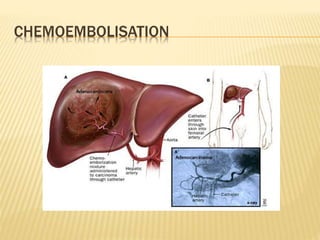 CHEMOEMBOLISATION
 