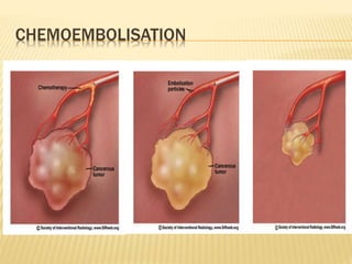 CHEMOEMBOLISATION
 