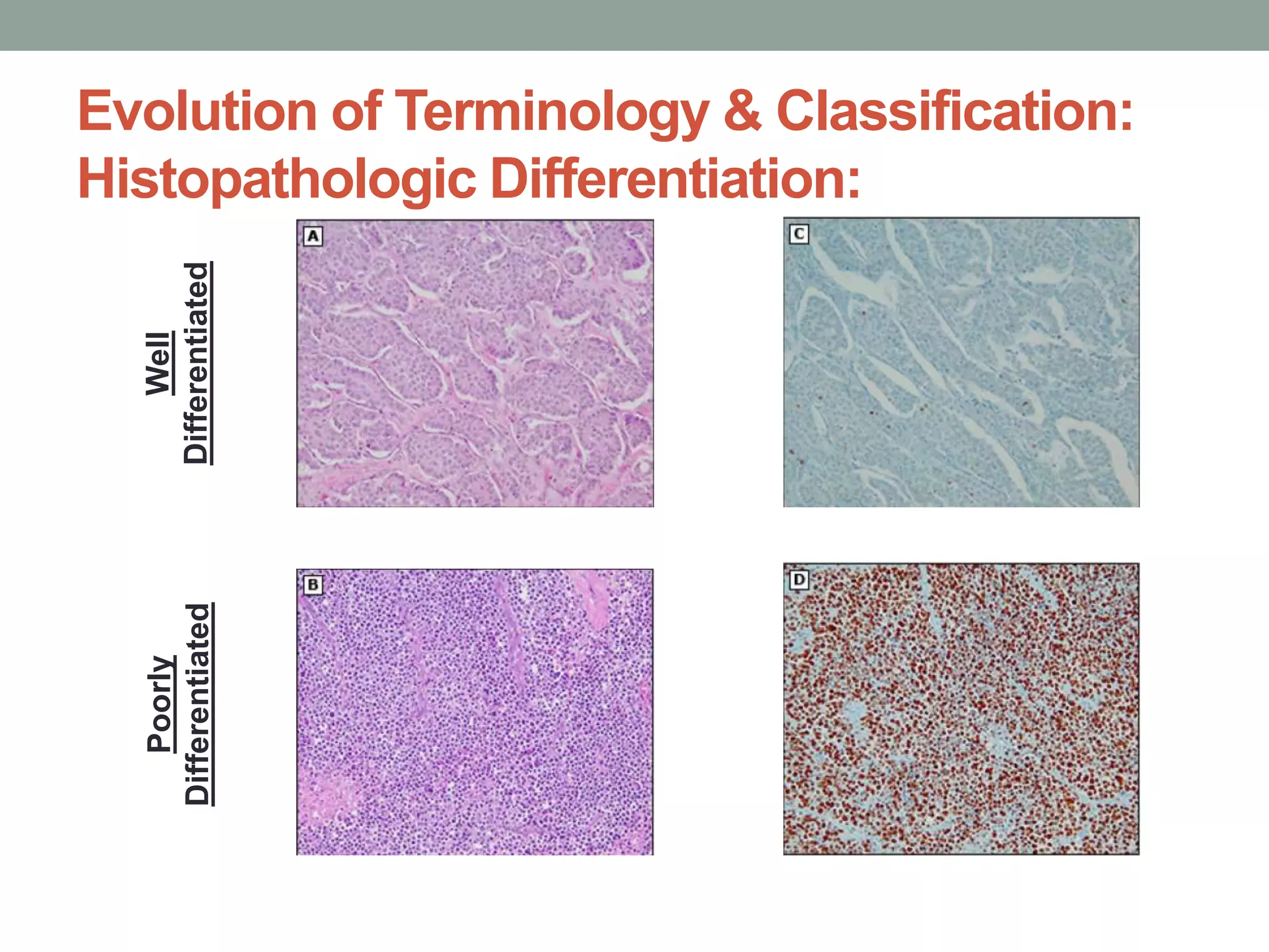 Evolution of Terminology & Classification:
Histopathologic Differentiation:
Well
Differentiated
Poorly
Differentiated
 
