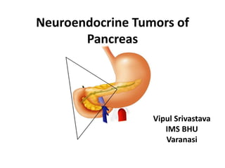 Neuroendocrine Tumors of
Pancreas
Vipul Srivastava
IMS BHU
Varanasi
 