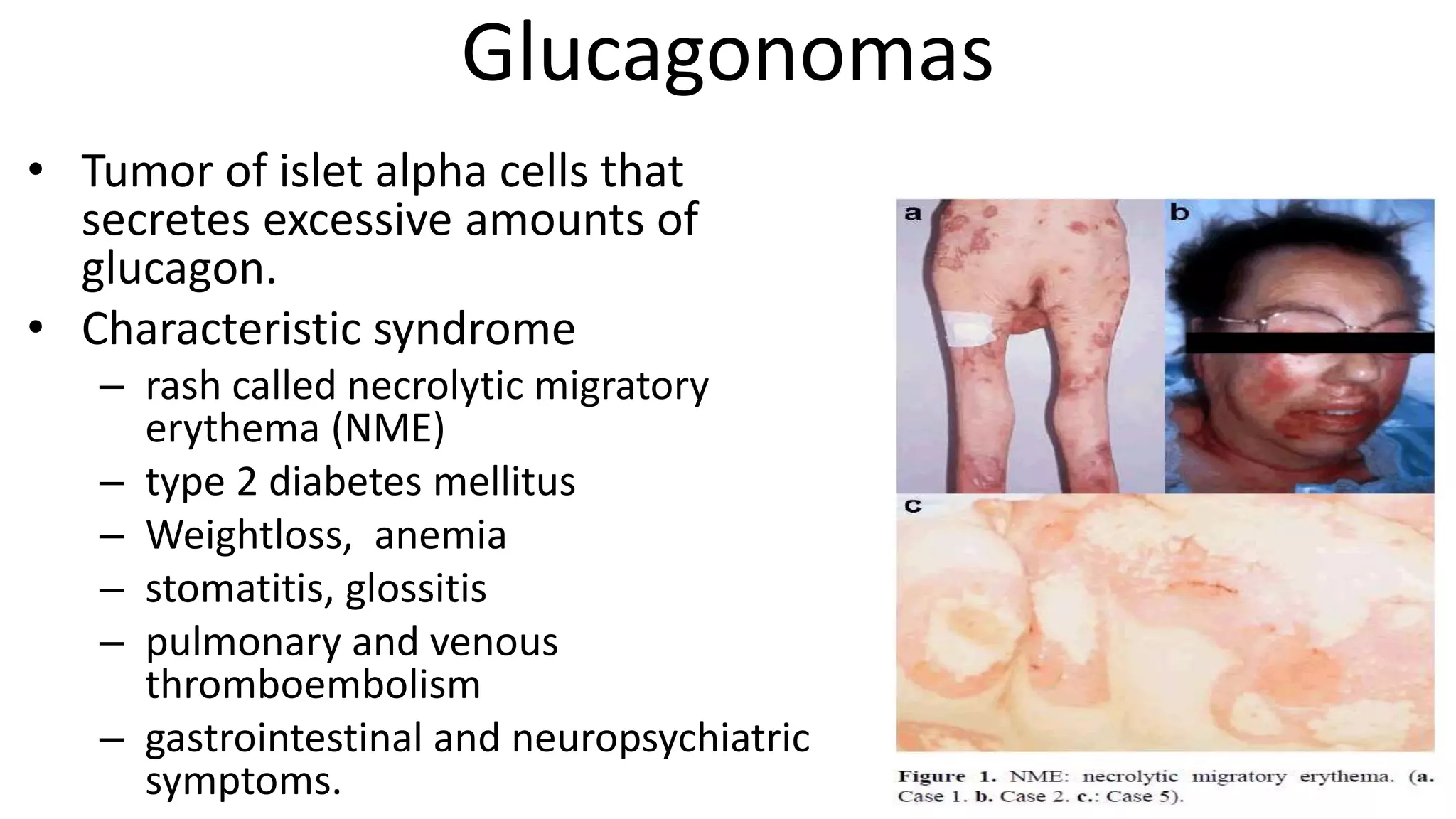 Neuroendocrine tumors of pancreas | PPTX
