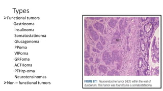 Vipoma Radiology NEUROENDOCRINE TUMORS OF PANCREAS.pptx