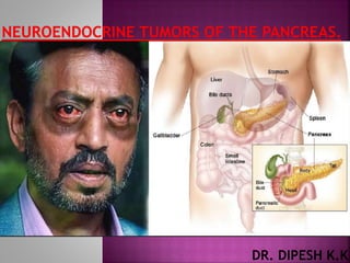 Neuroendocrine tumors of the pancreas | PPTX