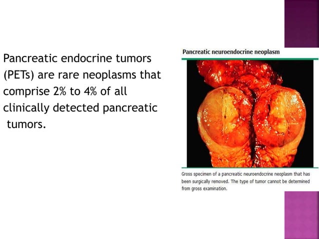 Fresh Look at Neuroendocrine Tumors Of The Pancreas