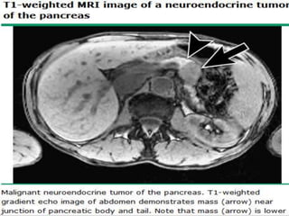 Neuroendocrine tumors of the pancreas | PPTX