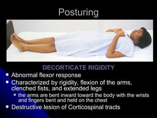 Posturing DECORTICATE RIGIDITY Abnormal flexor response Characterized by rigidity, flexion of the arms, clenched fists, and extended legs the arms are bent inward toward the body with the wrists and fingers bent and held on the chest Destructive lesion of Corticospinal tracts 