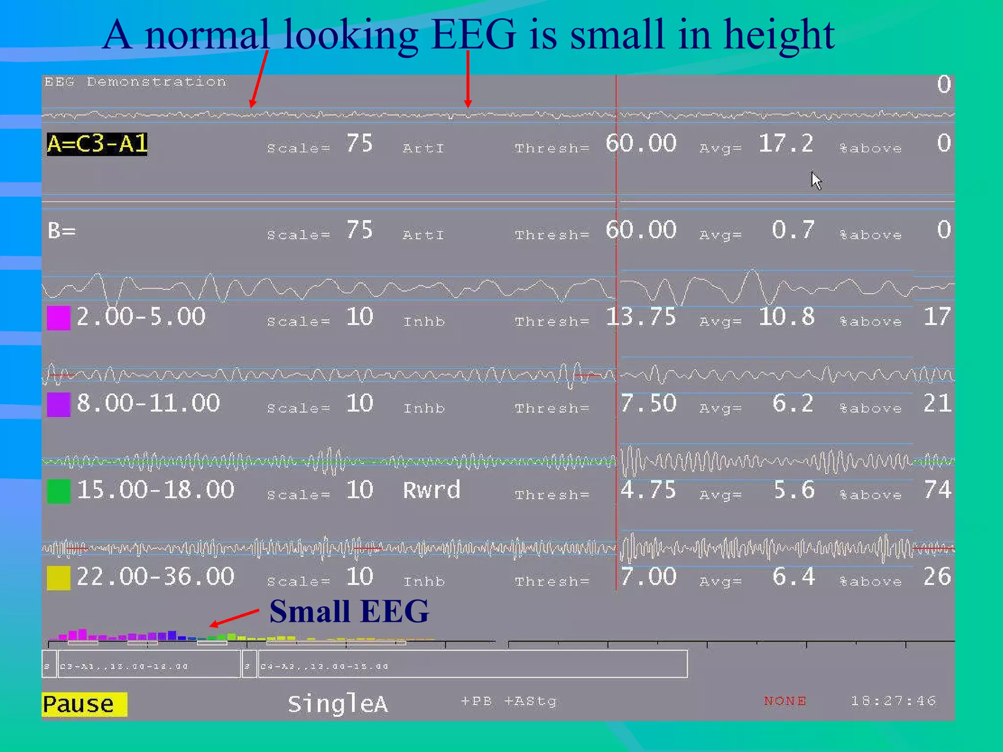 A normal looking EEG is small in height Small EEG   