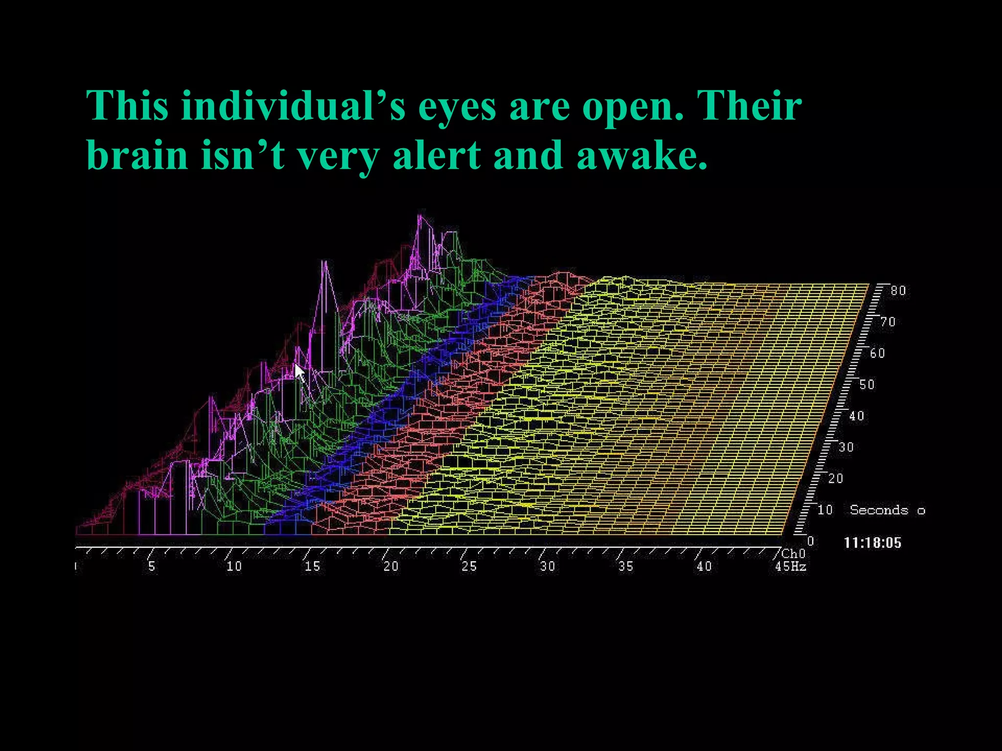 This individual’s eyes are open. Their brain isn’t very alert and awake.   