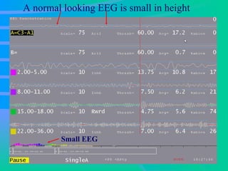 A normal looking EEG is small in height Small EEG   