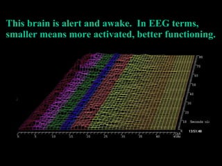 This brain is alert and awake.  In EEG terms, smaller means more activated, better functioning. 