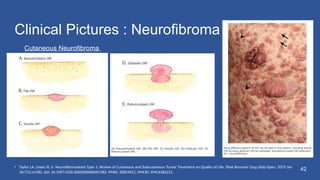 neurofibroma-neurofibromatosis-comparison-and-treatment-pptx