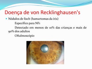 Doença de von Recklinghausen's
 Nódulos de lisch (hamartomas da íris)
Específico para NF1
Detectado em menos de 10% das crianças e mais de
90% dos adultos
Oftalmoscópio
 