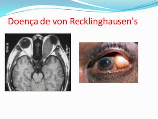Doença de von Recklinghausen's
 