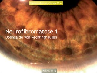Neurofibromatose 1
Doença de Von Recklinghausen
Universidade do Grande R io
Junho, 2013
 