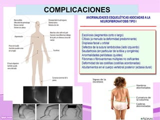 COMPLICACIONES
 