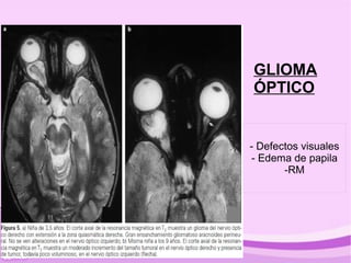 GLIOMA
ÓPTICO


- Defectos visuales
- Edema de papila
       -RM
 
