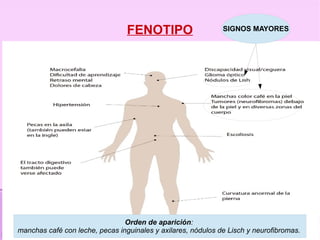 FENOTIPO                     SIGNOS MAYORES




                                Orden de aparición:
manchas café con leche, pecas inguinales y axilares, nódulos de Lisch y neurofibromas.
 