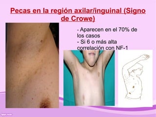 Pecas en la región axilar/inguinal (Signo
               de Crowe)
                    - Aparecen en el 70% de
                    los casos
                    - Si 6 o más alta
                    correlación con NF-1
 