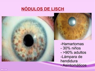 NÓDULOS DE LISCH




              -Hamartomas
              - 30% niños
              - >90% adultos
              -Lámpara de
              hendidura
              - Asintomáticos
 