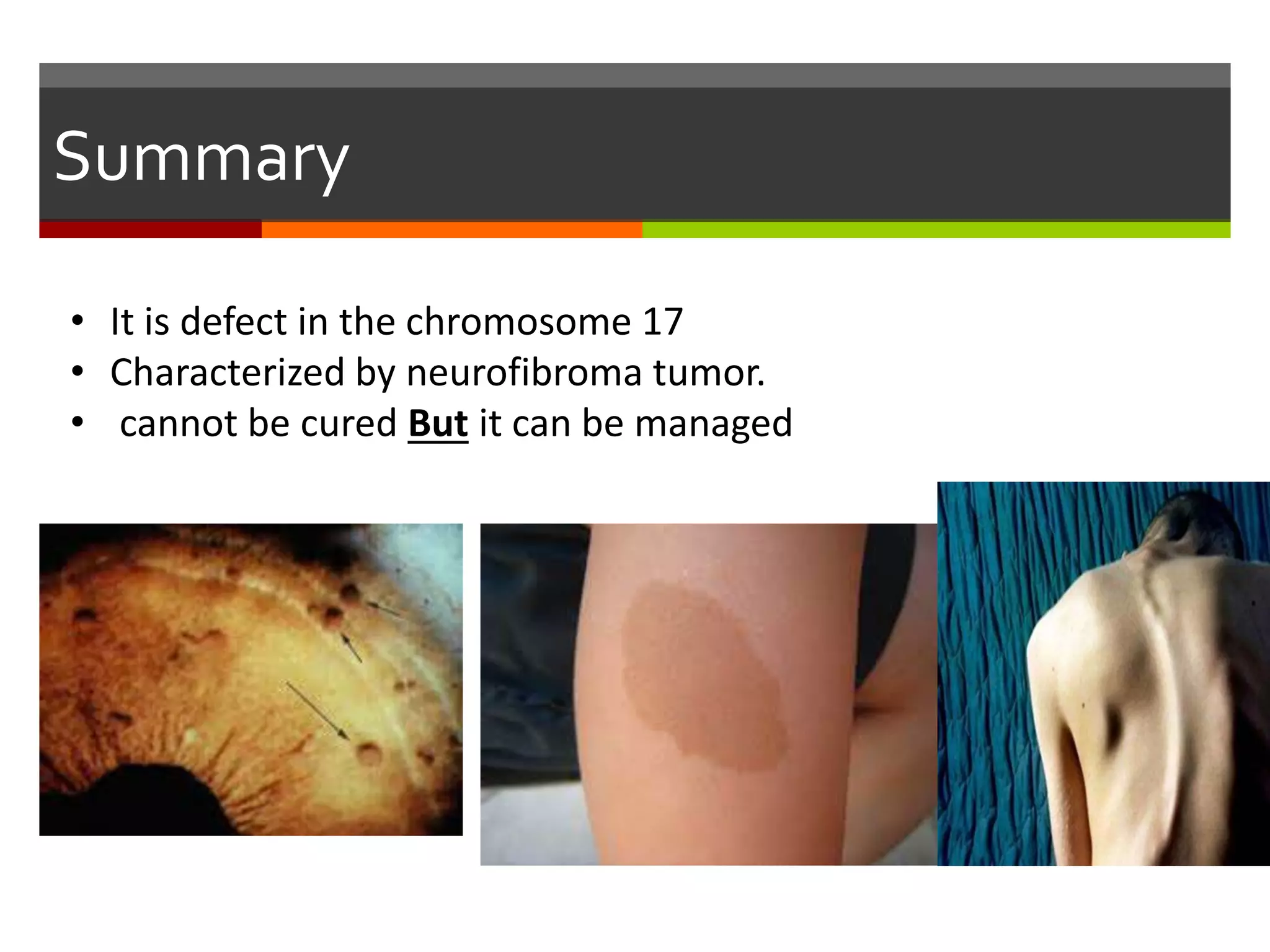 neurofibromatosis-ppt