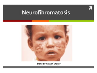 
Neurofibromatosis
Done by Hassan Shaker
 