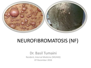 NEUROFIBROMATOSIS (NF)
Dr. Basil Tumaini
Resident, Internal Medicine (MUHAS)
07 December 2016
 