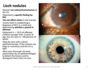 Neurofibromatosis Type 1 Lisch Nodules Neurofibromatosis Type 1 Lisch Nodules