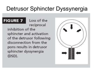 Detrusor Sphincter Dyssynergia
 