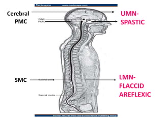 UMN-
SPASTIC
LMN-
FLACCID
AREFLEXIC
Cerebral
PMC
SMC
 