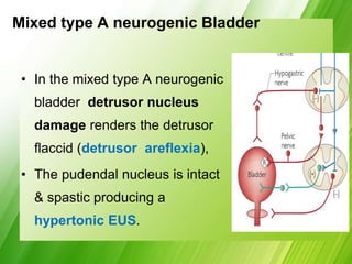 Mixed type A neurogenic Bladder
• In the mixed type A neurogenic
bladder detrusor nucleus
damage renders the detrusor
flaccid (detrusor areflexia),
• The pudendal nucleus is intact
& spastic producing a
hypertonic EUS.
 