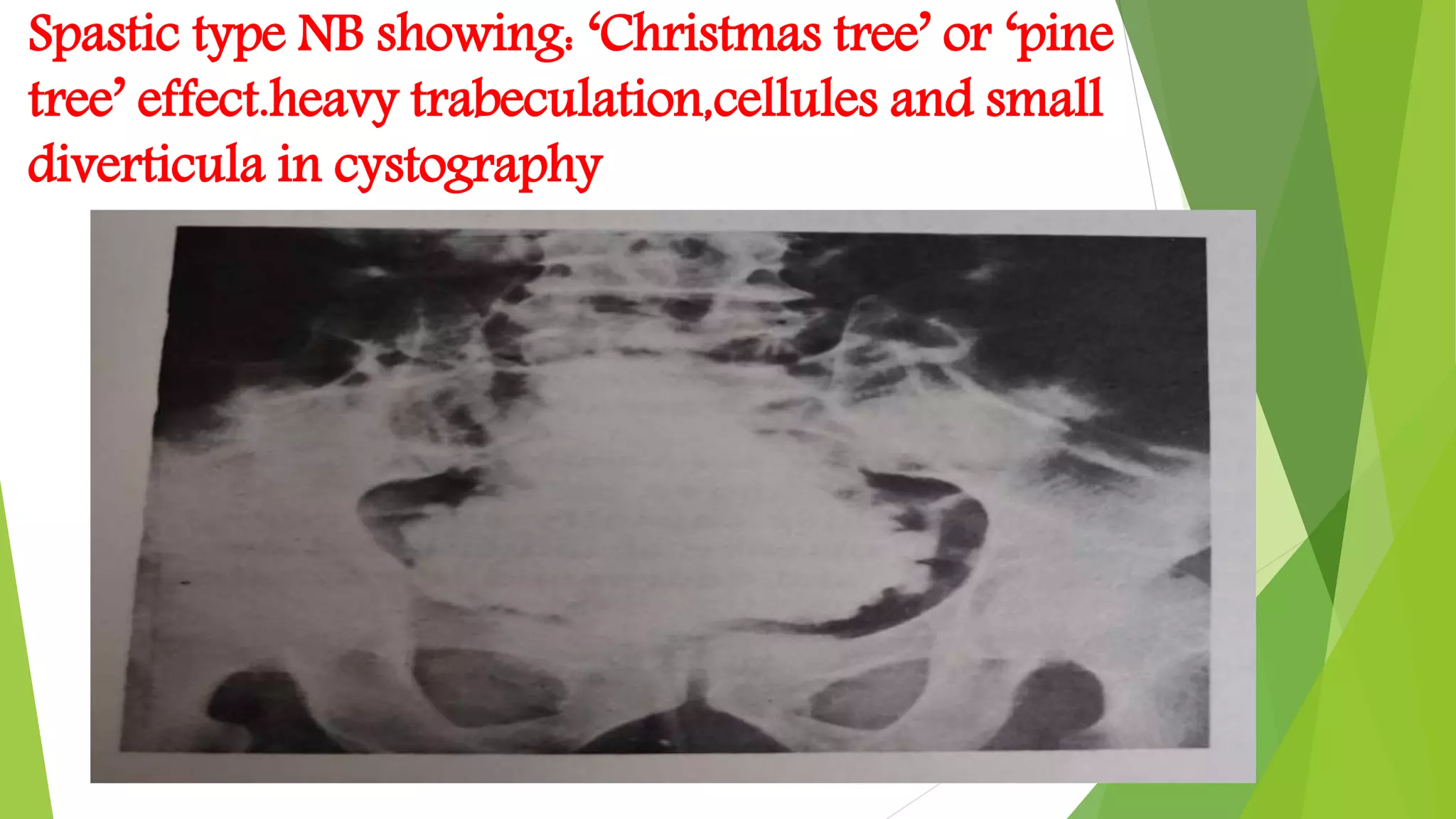 Spastic type NB showing: ‘Christmas tree’ or ‘pine
tree’ effect.heavy trabeculation,cellules and small
diverticula in cystography
 