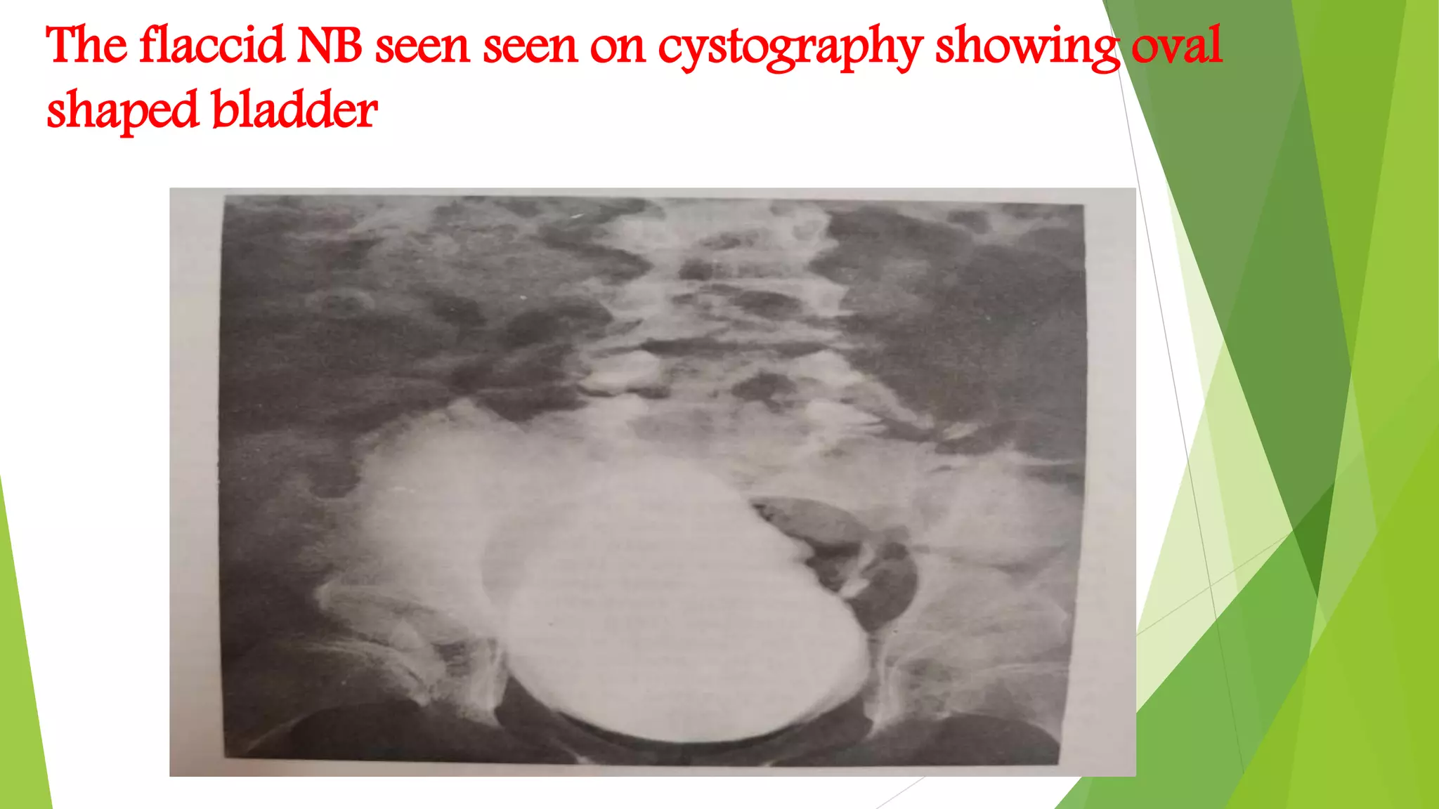 The flaccid NB seen seen on cystography showing oval
shaped bladder
 