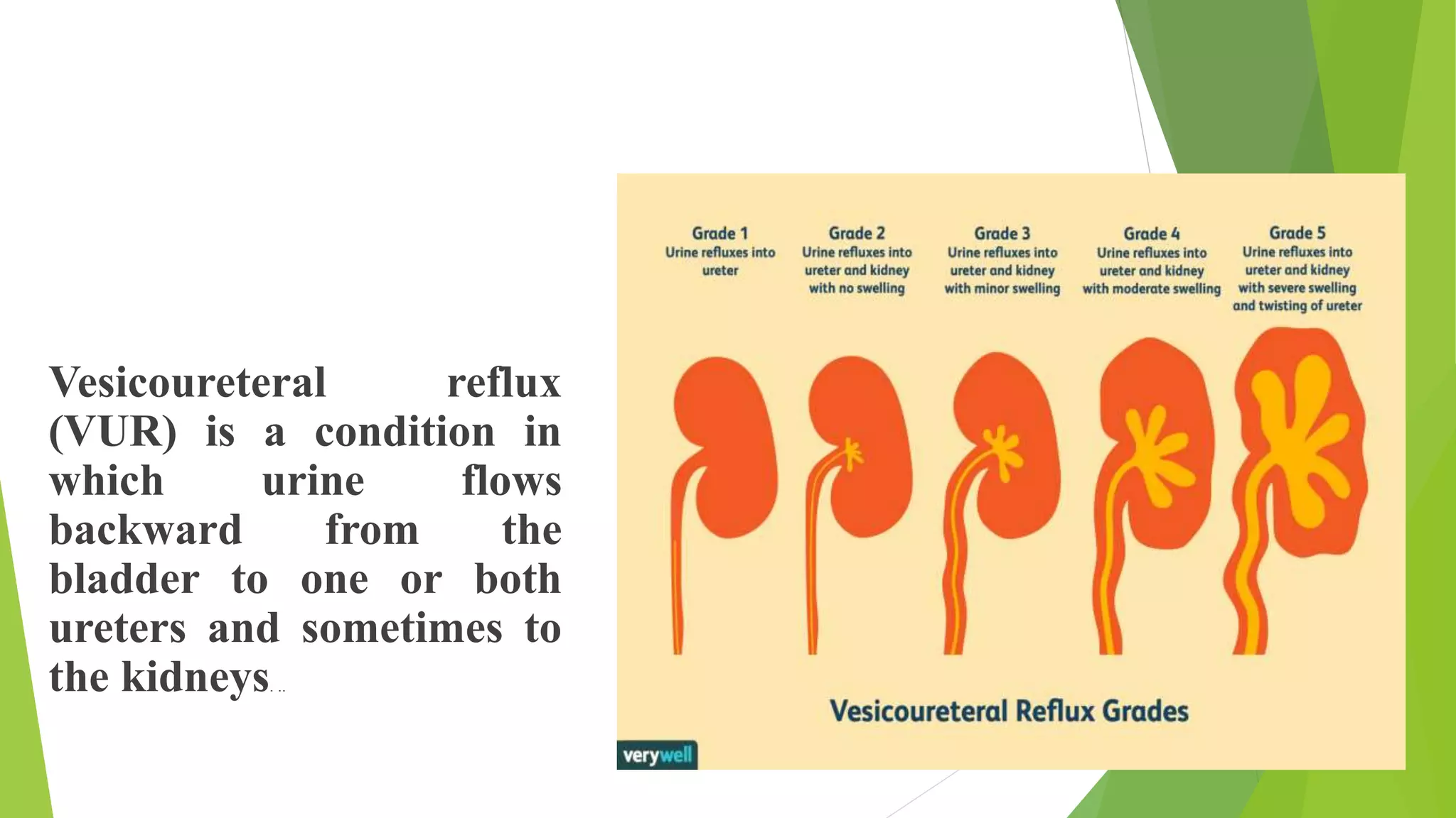 icourethral reflux:-
Vesicoureteral reflux
(VUR) is a condition in
which urine flows
backward from the
bladder to one or both
ureters and sometimes to
the kidneys. ..
 