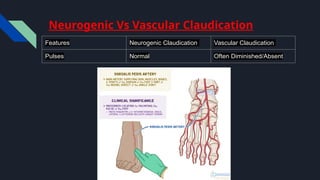 Neurogenic Claudication.. Pptx file.... | PPTX