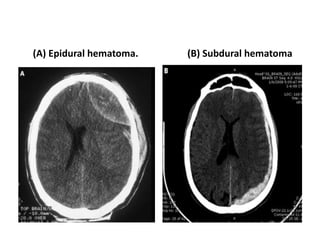 (A) Epidural hematoma. (B) Subdural hematoma
 