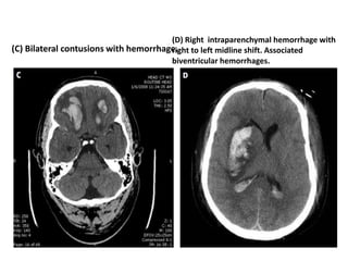 (C) Bilateral contusions with hemorrhage.
(D) Right intraparenchymal hemorrhage with
right to left midline shift. Associated
biventricular hemorrhages.
 