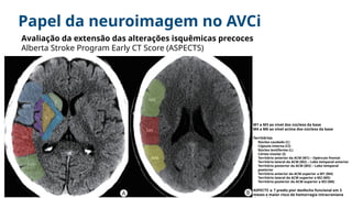 Neuroimagem no AVCi - congresso de trauma e emergencia unicamp | PPTX