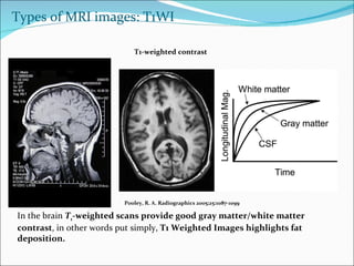 Pooley, R. A. Radiographics 2005;25:1087-1099 T1-weighted contrast In the brain  T 1 -weighted scans provide good gray matter/white matter contrast , in other words put simply,  T1 Weighted Images highlights fat deposition. Types of MRI images: T1WI 