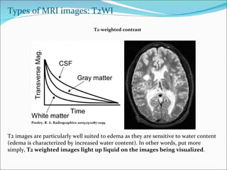 Pooley, R. A. Radiographics 2005;25:1087-1099 T2-weighted contrast Types of MRI images: T2WI T2 images are particularly well suited to edema as they are sensitive to water content (edema is characterized by increased water content). In other words, put more simply,  T2 weighted images light up liquid on the images being visualized . 