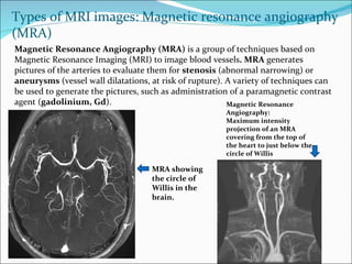 Magnetic Resonance Angiography (MRA)  is a group of techniques based on Magnetic Resonance Imaging (MRI) to image blood vessels . MRA  generates pictures of the arteries to evaluate them for  stenosis  (abnormal narrowing) or  aneurysms  (vessel wall dilatations, at risk of rupture). A variety of techniques can be used to generate the pictures, such as administration of a paramagnetic contrast agent ( gadolinium, Gd ). Types of MRI images: Magnetic resonance angiography (MRA) Magnetic Resonance Angiography: Maximum intensity projection of an MRA covering from the top of the heart to just below the circle of Willis MRA showing the circle of Willis in the brain.  