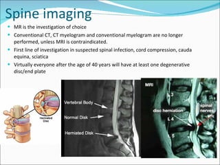 Spine imaging MR is the investigation of choice Conventional CT, CT myelogram and conventional myelogram are no longer performed, unless MRI is contraindicated. First line of investigation in suspected spinal infection, cord compression, cauda equina, sciatica Virtually everyone after the age of 40 years will have at least one degenerative disc/end plate 
