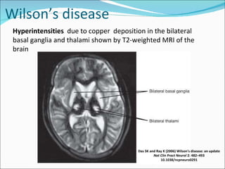 Wilson’s disease Das SK and Ray K (2006) Wilson's disease: an update Nat Clin Pract  Neurol   2: 482 – 493 10.1038/ncpneuro0291 Hyperintensities   due to copper  deposition in the bilateral basal ganglia and thalami shown by T2-weighted MRI of the brain 
