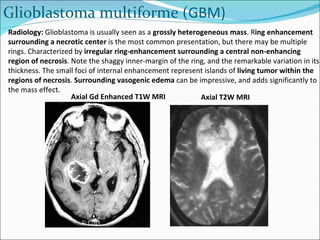 Radiology:  Glioblastoma is usually seen as a  grossly heterogeneous mass . R ing enhancement surrounding a necrotic center  is the most common presentation, but there may be multiple rings. Characterized by  irregular ring-enhancement surrounding a central non-enhancing region of necrosis . Note the shaggy inner-margin of the ring, and the remarkable variation in its thickness. The small foci of internal enhancement represent islands of  living tumor within the regions of necrosis .  Surrounding vasogenic edema  can be impressive, and adds significantly to the mass effect.  Glioblastoma multiforme ( GBM) Axial Gd Enhanced T1W MRI Axial T2W MRI 