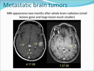 MRI appearance two months after whole brain radiation (small lesions gone and large lesion much smaller) Metastatic brain tumors 