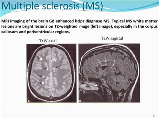 Multiple sclerosis (MS) Axial Gd Enhanced T1W MR Axial T2W MR MRI imaging of the brain Gd enhanced helps diagnose MS. Typical MS white matter lesions are bright lesions on T2-weighted image (left image), especially in the corpus callosum and periventricular regions. T2W axial T2W sagittal 