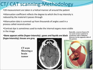 CT/ CAT scanning: Methodology 2D measurement are taken in a helical manner all around the patient Attenuation coefficient reflects the degree to which the X-ray intensity is reduced by the material it passes through Attenuation data is summed up from thousands of angles used in a process called reconstruction Contrast dye is sometimes used to make the internal organs more visible in the image Bone appears white (hyper-intensity) ; gases and liquids are black (hypo-intensity); tissues are gray Basically, a narrow beam of X ray scans across a patient in synchrony with a radiation detector on the opposite side of the patient. CT scan  Showing a  brain tumor 