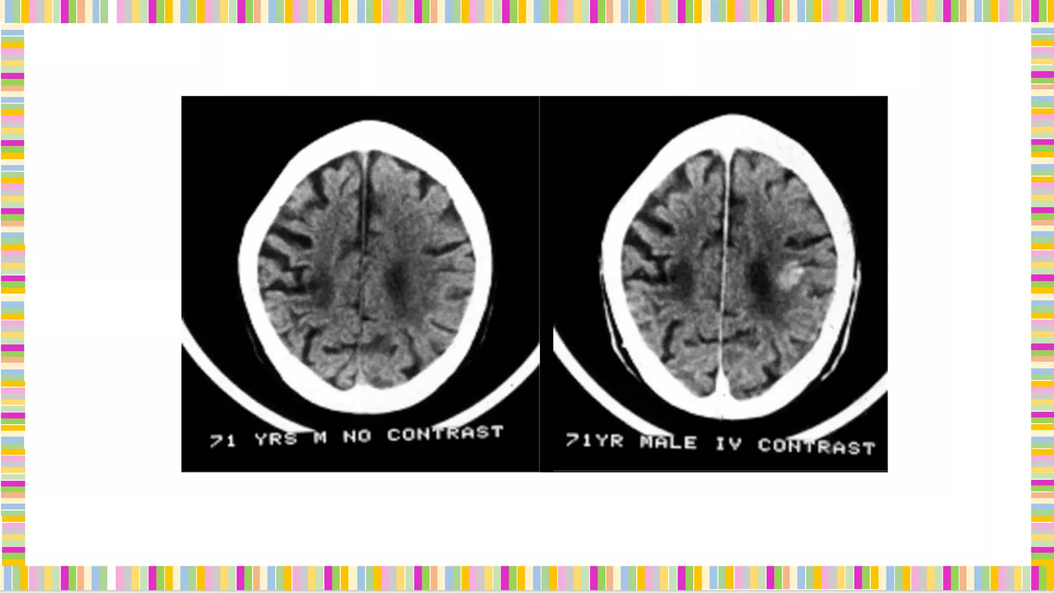 Neuroimaging in Psychiatry | PPT