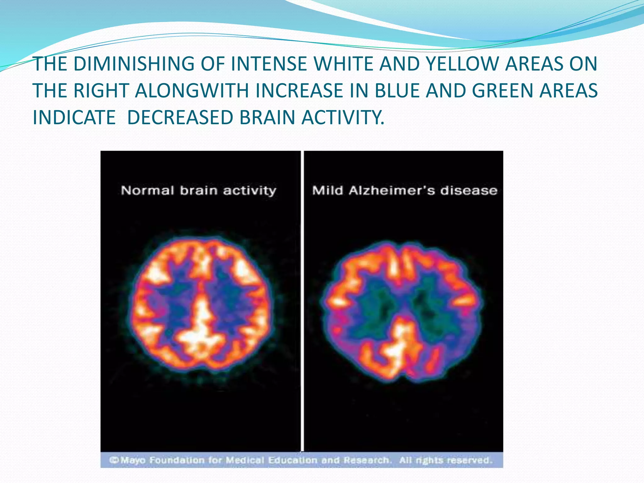 THE DIMINISHING OF INTENSE WHITE AND YELLOW AREAS ON 
THE RIGHT ALONGWITH INCREASE IN BLUE AND GREEN AREAS 
INDICATE DECREASED BRAIN ACTIVITY. 
 