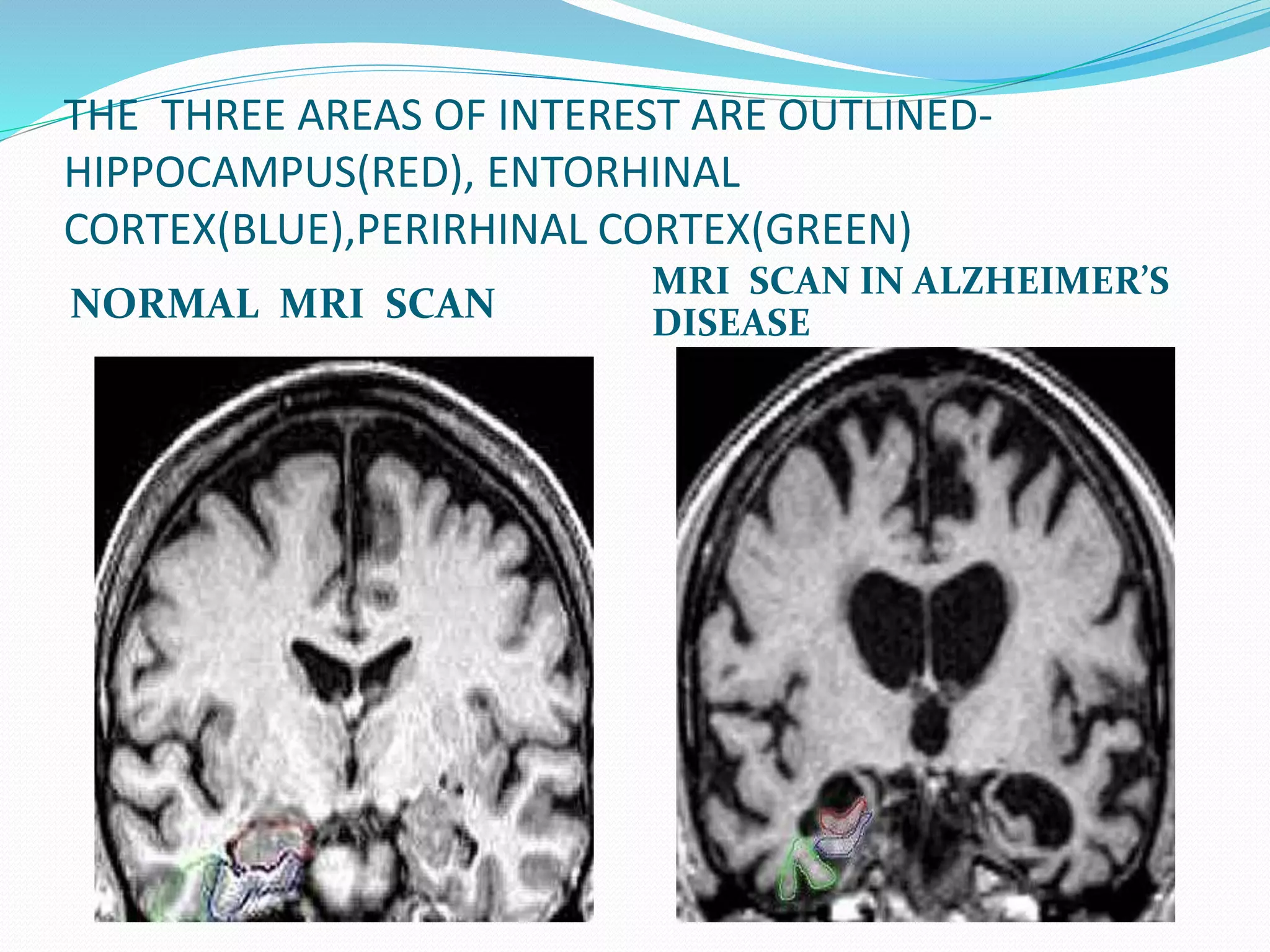 THE THREE AREAS OF INTEREST ARE OUTLINED-HIPPOCAMPUS( 
RED), ENTORHINAL 
CORTEX(BLUE),PERIRHINAL CORTEX(GREEN) 
NORMAL MRI SCAN 
MRI SCAN IN ALZHEIMER’S 
DISEASE 
 